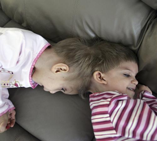 Conjoined twin sisters Anastasia Dogaru, right, and Tatiana lay on a couch in their apartment in Dallas, Friday, March 23, 2007. Doctors began the first in a series of high-risk surgeries Wednesday, June 6, 2007 to separate the 3-year-olds joined at the h The Associated Press
