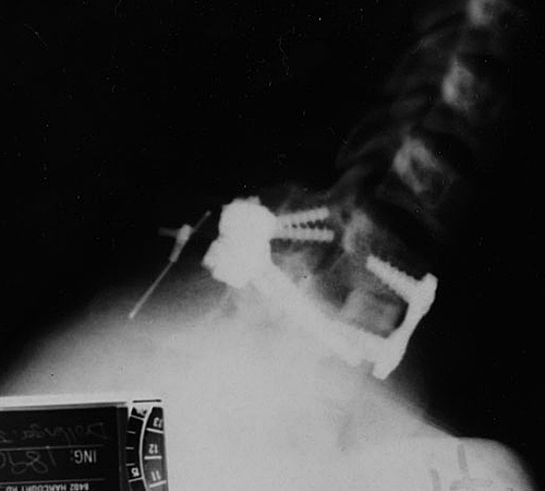Following a surgical procedure to repair a subluxation of the C7-T1 vertebrae, senior gymnast Jon Drollinger had 10 screws, two plates and two rods placed in his neck to repair damage, as seen in the above X-ray from Oct. 2003. Photo courtesy of Jon Drollinger
